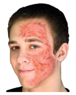 Burn Scar / Brandwunden Gel